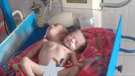 পঞ্চগড়ে দুই মাথাওয়ালা শিশুর জন্ম, দেড়ঘন্টা পর মৃত্যু